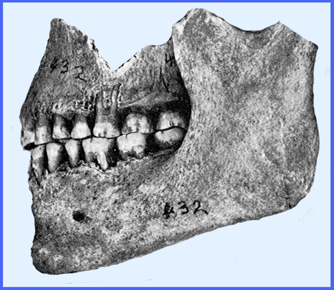 A very markedly Europoid type of skull with perfectly straight, vertical j